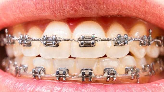 dis teli nasil takilir cesitleri ortodonti tedavisi