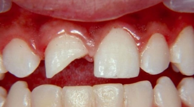 Kırık Diş Dolgusu Nasıl Yapılır ? Fiyatları • Güzeloba Diş Polikliniği