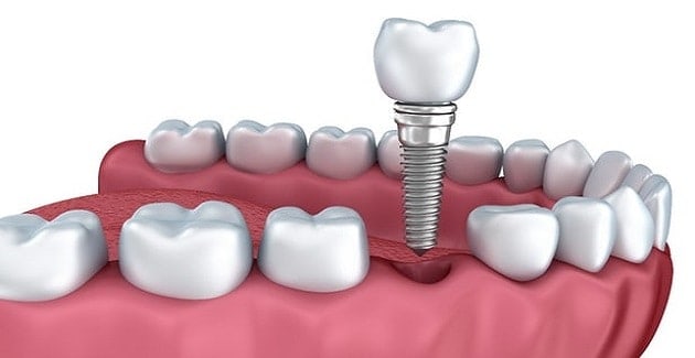 implant diş fiyatları yeni
