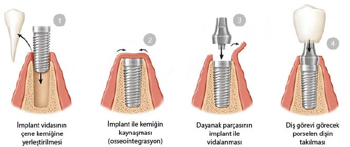 implant diş yapımı