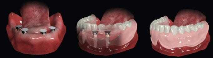 implant üstü protez diş