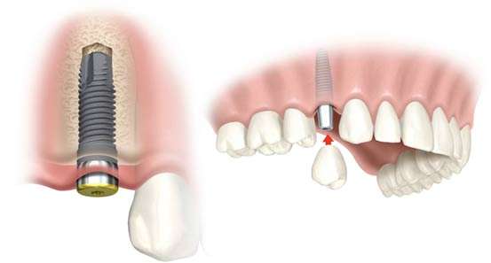implant vidalı diş