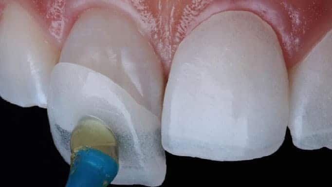 præmedicinering Sandet junk Lamine Diş Kaplama: Nedir, Nasıl Yapılır, Zararları Nelerdir?
