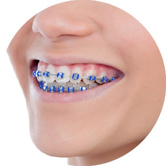 mavi diş teli