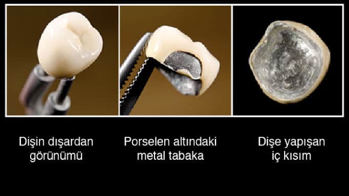 metal destekli porselen diş