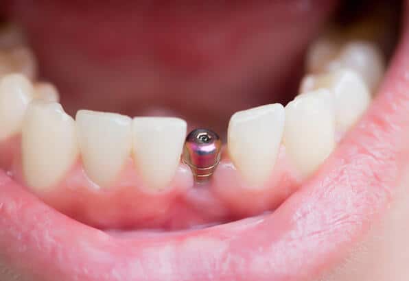 ön diş implant