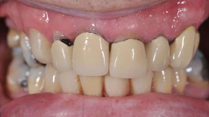 porselen diş zararları