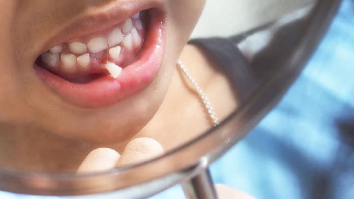 kırık diş tedavisi