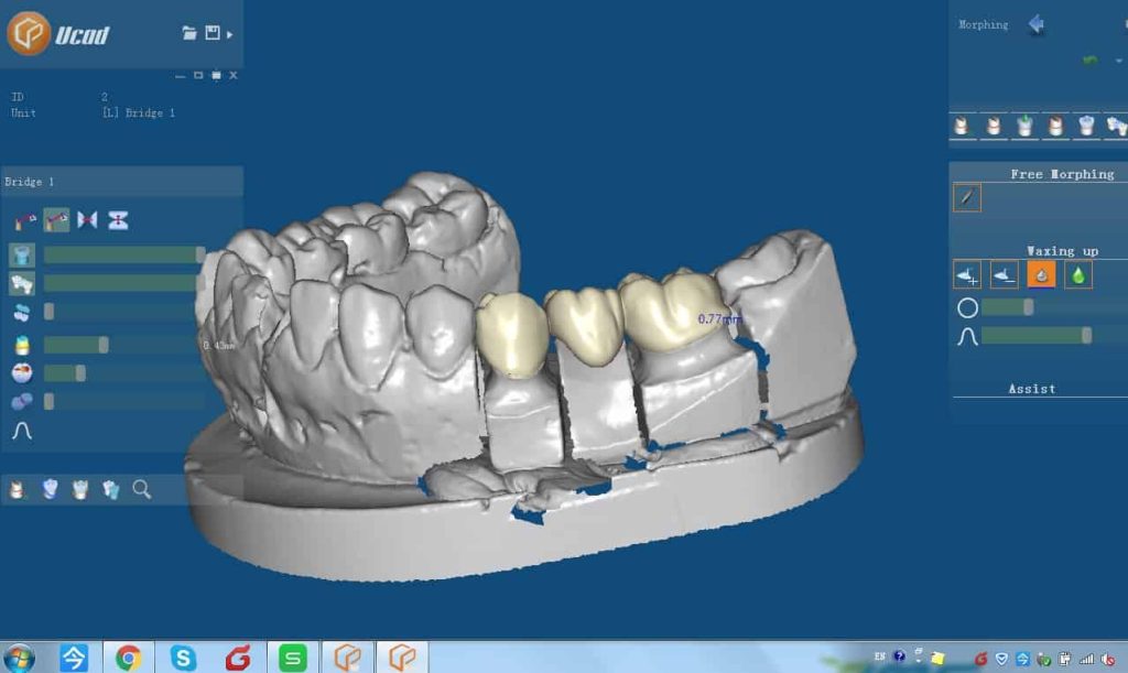 CAD-CAM zirkonyum diş