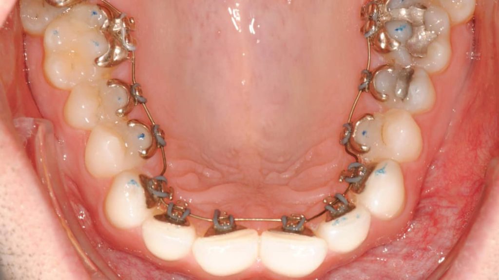 Lingual diş teli