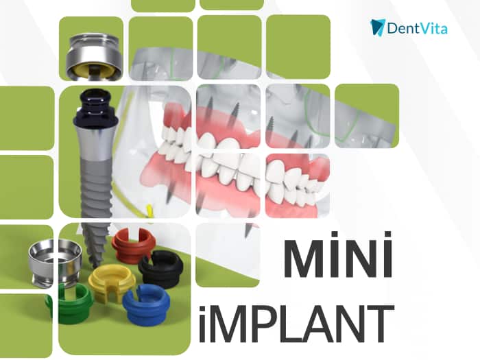 mini implant