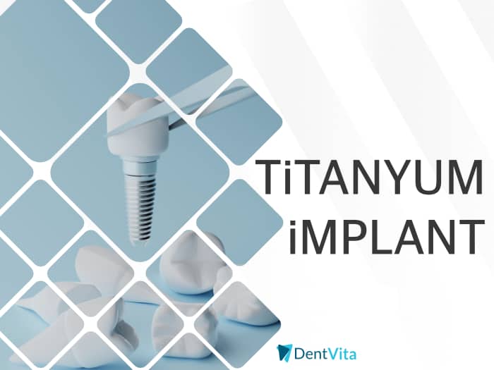 titanyum implant
