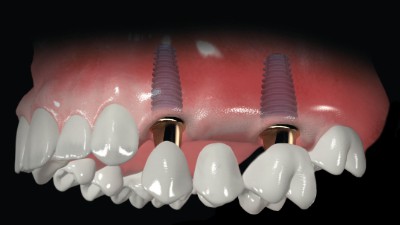 üç diş eksikliğinde implant köprü fiyatı hesaplama