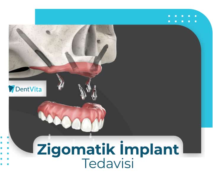 zigomatik implant