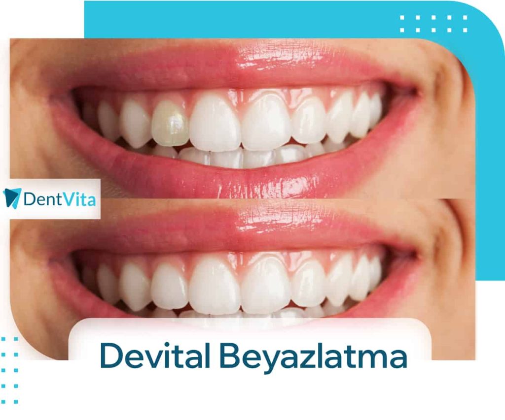 devital (kanal tedavili ölü diş) beyazlatma