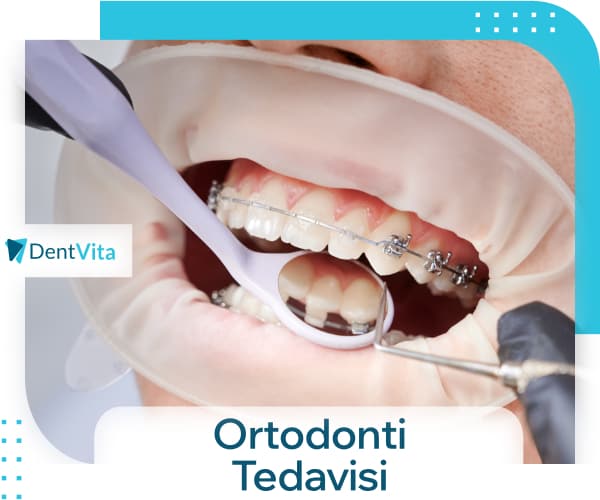ortodonti tedavisi